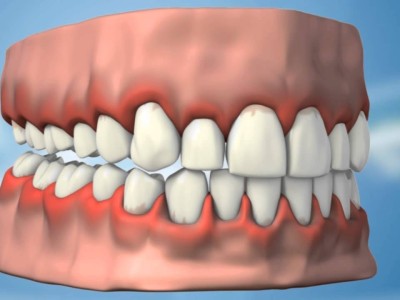 Dişeti Hastalıkları (Periodontal Hastalıklar) Nelerdir? Neden Oluşur?